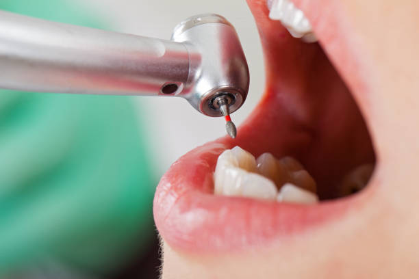 Best Emergency Broken Tooth Repair in Millcreek, UT